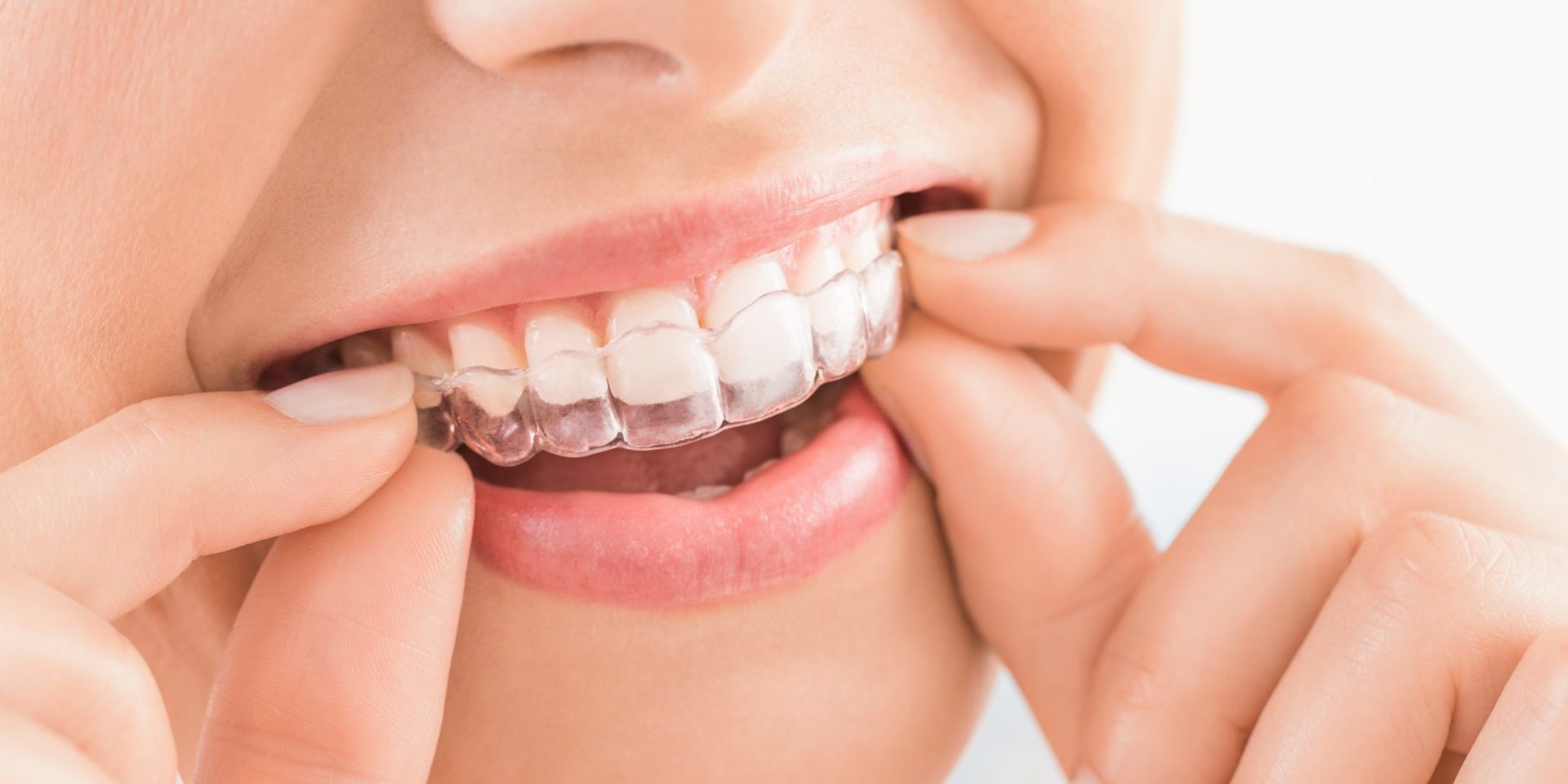 Esthetique dentaire Esthetique dentaire