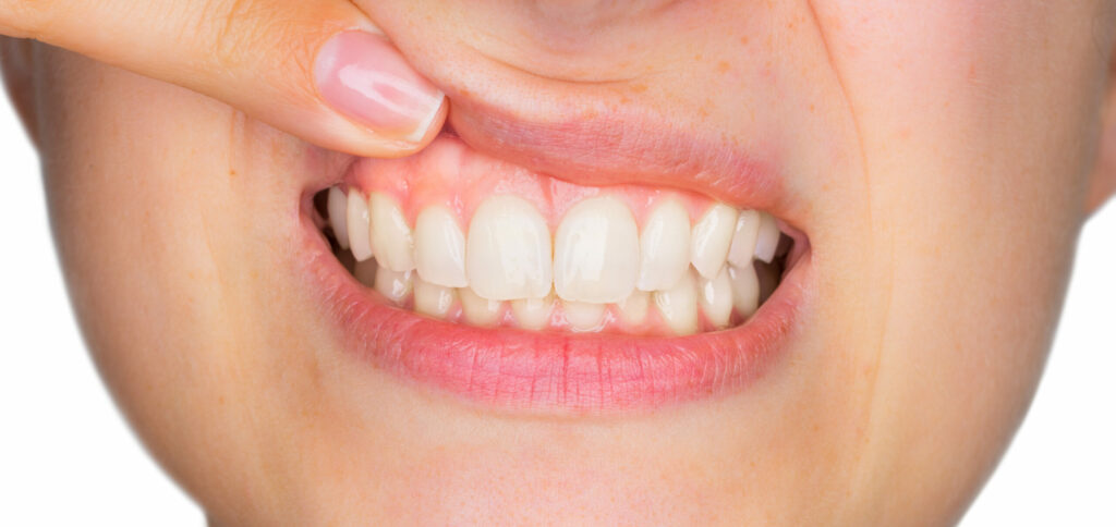 Soins des gencives Soins des gencives